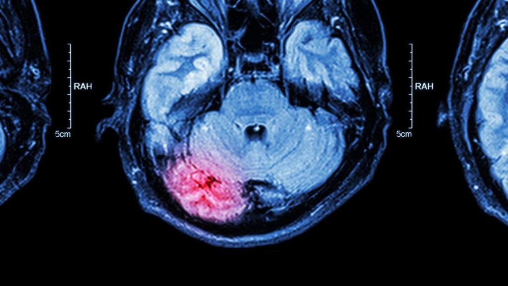 cannabis affects brain