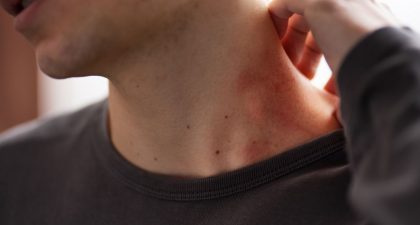 Lyme Disease Symptoms: Why They Linger After Treatment