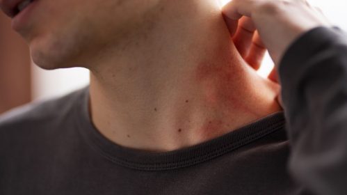 Lyme Disease Symptoms: Why They Linger After Treatment