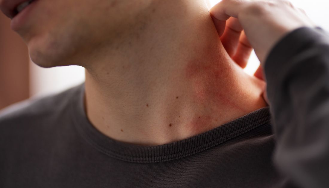 Lyme Disease Symptoms: Why They Linger After Treatment