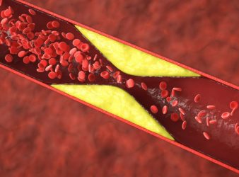 Statins and Depression