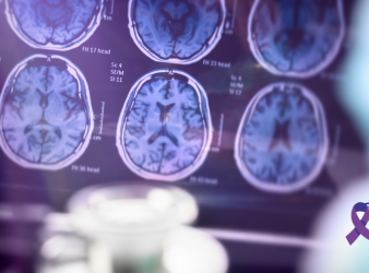 Alzheimer’s disease, cerebral blood flow, CDI test, mild cognitive impairment, USC research, vasomotor reactivity, cognitive decline, Doppler ultrasound, non-invasive diagnosis, neurodegenerative disease, brain oxygenation, NIH study, tau tangles, amyloid plaques, transcutaneous vagal stimulation