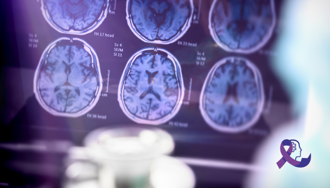 Alzheimer’s disease, cerebral blood flow, CDI test, mild cognitive impairment, USC research, vasomotor reactivity, cognitive decline, Doppler ultrasound, non-invasive diagnosis, neurodegenerative disease, brain oxygenation, NIH study, tau tangles, amyloid plaques, transcutaneous vagal stimulation