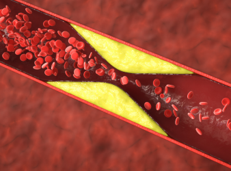 atherosclerosis, oral bacteria, viridans streptococci, coronary plaques, cardiovascular disease, bacterial biofilms, dental health and heart disease, inflammation and heart disease, TLR2 pathway, myocardial infarction risk, sudden cardiac death, oral microbes and atherosclerosis, infective endocarditis, heart disease prevention, cardiovascular microbiome