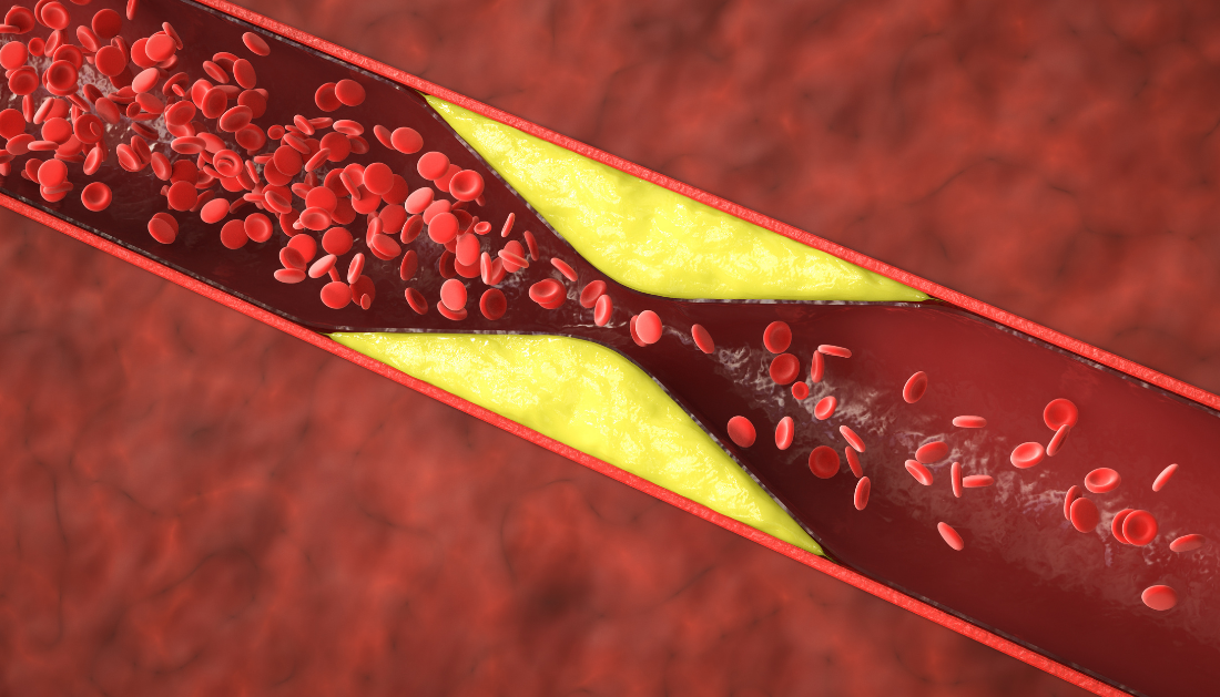 atherosclerosis, oral bacteria, viridans streptococci, coronary plaques, cardiovascular disease, bacterial biofilms, dental health and heart disease, inflammation and heart disease, TLR2 pathway, myocardial infarction risk, sudden cardiac death, oral microbes and atherosclerosis, infective endocarditis, heart disease prevention, cardiovascular microbiome