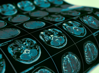 seizure prediction, epilepsy, deep learning AI, future-guided AI, EEG monitoring, personalized medicine, neurology, predictive analytics, patient safety, wearable EEG, real-time seizure forecast, clinical AI, hospital neurology, epilepsy research, AI in healthcare