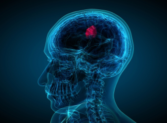 glioblastoma, focused ultrasound, brain cancer research, temozolomide, neuro-oncology, liquid biopsy, MRI-guided therapy, blood–brain barrier, clinical trials, oncology news, cancer biomarkers, UMSOM, chemotherapy delivery, HCP oncology updates, eMedEvents news