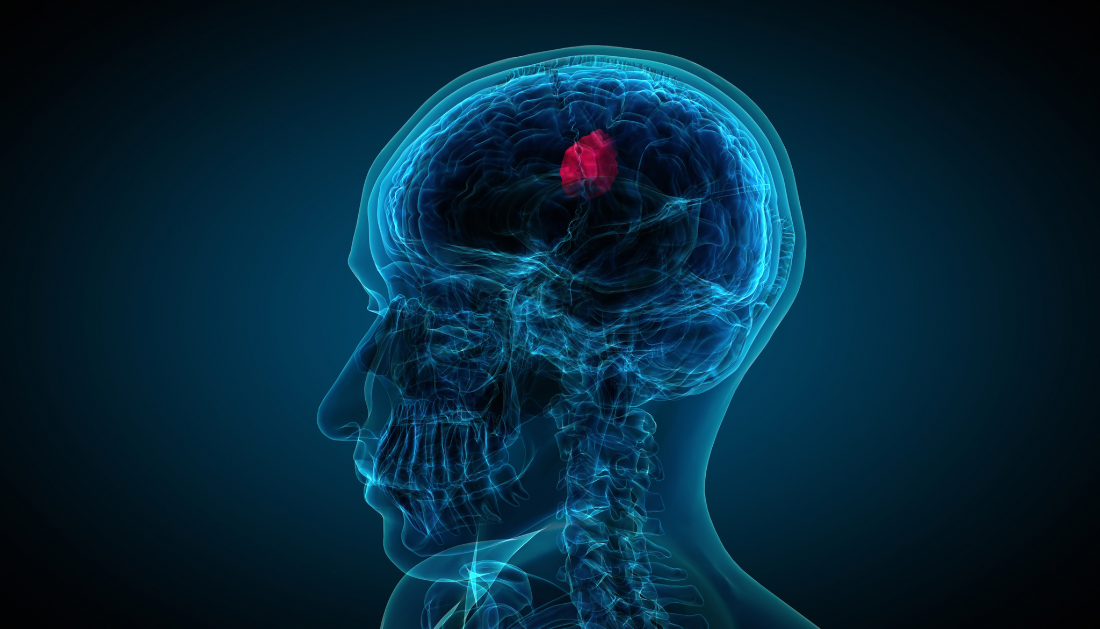 glioblastoma, focused ultrasound, brain cancer research, temozolomide, neuro-oncology, liquid biopsy, MRI-guided therapy, blood–brain barrier, clinical trials, oncology news, cancer biomarkers, UMSOM, chemotherapy delivery, HCP oncology updates, eMedEvents news