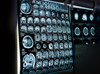 Parkinson’s Disease, microplastics, nanoplastics, neurodegeneration, environmental health, neuroinflammation, gut-brain axis, alpha-synuclein, mitochondrial dysfunction, public health research, neurology news, medical research, brain health, plastic pollution, alpha-synuclein aggregation, blood–brain barrier, neuroinflammation, ferroptosis, Lewy bodies, plastic pollution, environmental neurotoxins