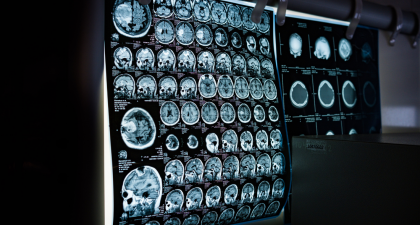 Acute Ischemic Stroke, Neuroprotective Drugs, Loberamisal, Stroke Recovery, Phase III Clinical Trial, Neuroprotection, NIHSS, Modified Rankin Scale, Stroke Research, International Stroke Conference, American Stroke Association, IV Stroke Therapy, Brain Health, HCP Education, NIHSS score, modified Rankin Scale, stroke clinical trial, brain cell protection, intravenous stroke therapy, stroke outcomes, American Stroke Association, International Stroke Conference