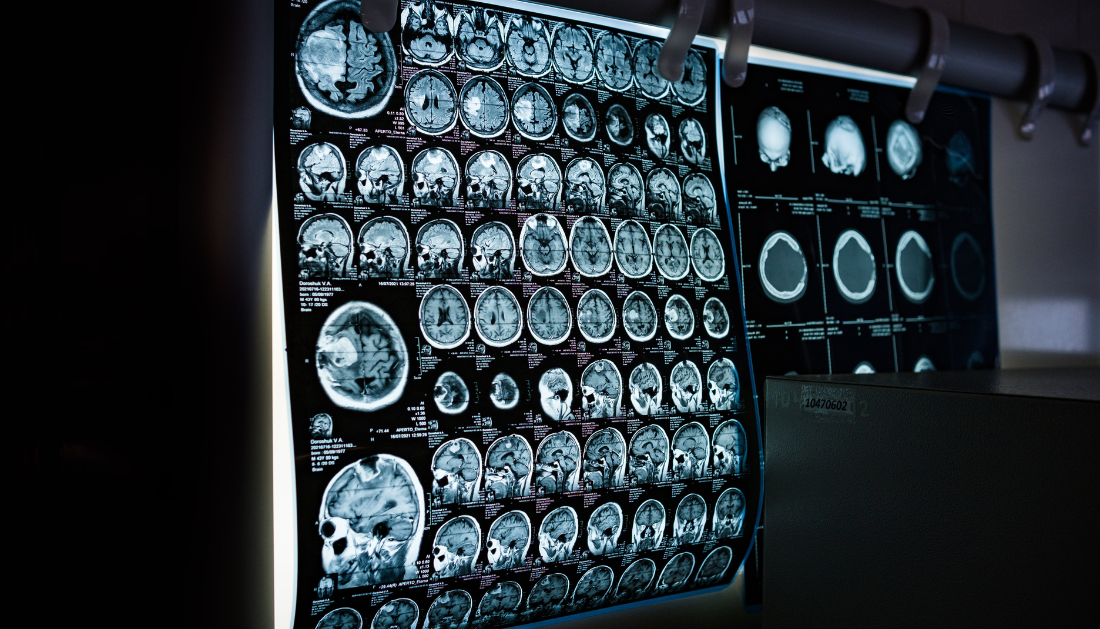 Acute Ischemic Stroke, Neuroprotective Drugs, Loberamisal, Stroke Recovery, Phase III Clinical Trial, Neuroprotection, NIHSS, Modified Rankin Scale, Stroke Research, International Stroke Conference, American Stroke Association, IV Stroke Therapy, Brain Health, HCP Education, NIHSS score, modified Rankin Scale, stroke clinical trial, brain cell protection, intravenous stroke therapy, stroke outcomes, American Stroke Association, International Stroke Conference