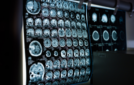 Stroke Rehabilitation, Stroke Recovery, Neurology Research, Physical Therapy, Neurorehabilitation, Clinical Trials, Brain Recovery, Stroke Care, Hand Function Recovery, Digital Therapy, Biomarkers, Acute Stroke, Therapy Intensity, Rehabilitation Science, stroke clinical trial, brain recovery after stroke, physical therapy stroke, digital rehabilitation therapy, stroke biomarkers, neurological recovery, therapy intensity stroke, acute stroke care, rehabilitation timing