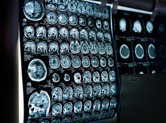 Stroke Rehabilitation, Stroke Recovery, Neurology Research, Physical Therapy, Neurorehabilitation, Clinical Trials, Brain Recovery, Stroke Care, Hand Function Recovery, Digital Therapy, Biomarkers, Acute Stroke, Therapy Intensity, Rehabilitation Science, stroke clinical trial, brain recovery after stroke, physical therapy stroke, digital rehabilitation therapy, stroke biomarkers, neurological recovery, therapy intensity stroke, acute stroke care, rehabilitation timing