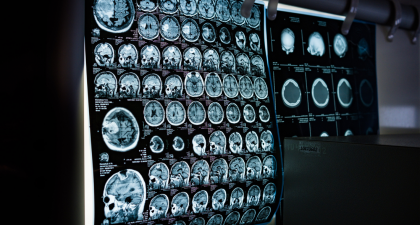 Stroke Rehabilitation, Stroke Recovery, Neurology Research, Physical Therapy, Neurorehabilitation, Clinical Trials, Brain Recovery, Stroke Care, Hand Function Recovery, Digital Therapy, Biomarkers, Acute Stroke, Therapy Intensity, Rehabilitation Science, stroke clinical trial, brain recovery after stroke, physical therapy stroke, digital rehabilitation therapy, stroke biomarkers, neurological recovery, therapy intensity stroke, acute stroke care, rehabilitation timing