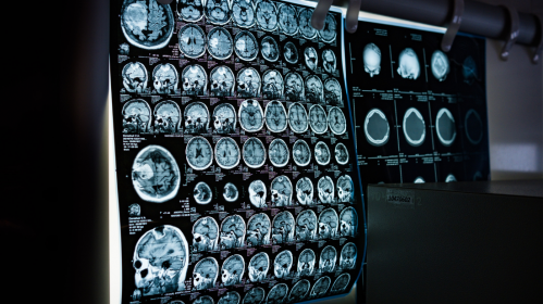 Stroke Rehabilitation, Stroke Recovery, Neurology Research, Physical Therapy, Neurorehabilitation, Clinical Trials, Brain Recovery, Stroke Care, Hand Function Recovery, Digital Therapy, Biomarkers, Acute Stroke, Therapy Intensity, Rehabilitation Science, stroke clinical trial, brain recovery after stroke, physical therapy stroke, digital rehabilitation therapy, stroke biomarkers, neurological recovery, therapy intensity stroke, acute stroke care, rehabilitation timing