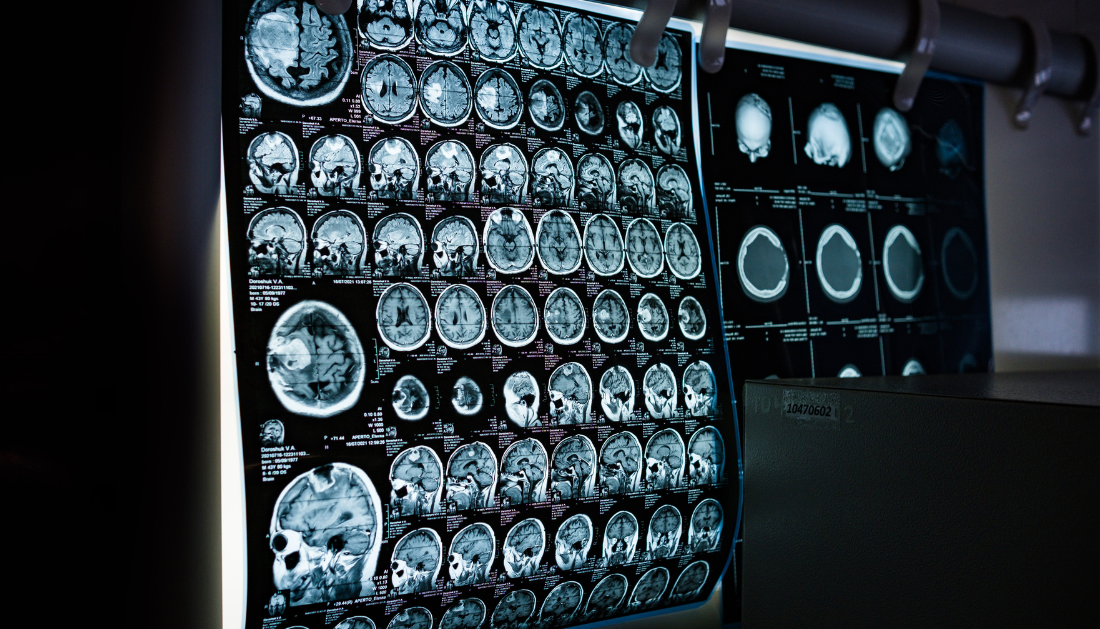 Stroke Rehabilitation, Stroke Recovery, Neurology Research, Physical Therapy, Neurorehabilitation, Clinical Trials, Brain Recovery, Stroke Care, Hand Function Recovery, Digital Therapy, Biomarkers, Acute Stroke, Therapy Intensity, Rehabilitation Science, stroke clinical trial, brain recovery after stroke, physical therapy stroke, digital rehabilitation therapy, stroke biomarkers, neurological recovery, therapy intensity stroke, acute stroke care, rehabilitation timing