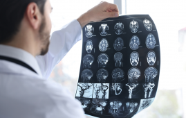 Low birthweight, Stroke risk, Ischemic stroke, Intracerebral hemorrhage, BMI, Early adulthood stroke, Cardiovascular risk, Neurology research, Epidemiology, Preventive medicine, Birth outcomes, Public health, Sweden study, Stroke prevention, Risk factors, gestational age stroke risk, stroke epidemiology, cardiovascular risk factors, neurology research stroke, stroke prevention strategies, population cohort study stroke, adult stroke risk factors, Sweden stroke study