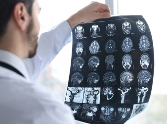 Low birthweight, Stroke risk, Ischemic stroke, Intracerebral hemorrhage, BMI, Early adulthood stroke, Cardiovascular risk, Neurology research, Epidemiology, Preventive medicine, Birth outcomes, Public health, Sweden study, Stroke prevention, Risk factors, gestational age stroke risk, stroke epidemiology, cardiovascular risk factors, neurology research stroke, stroke prevention strategies, population cohort study stroke, adult stroke risk factors, Sweden stroke study