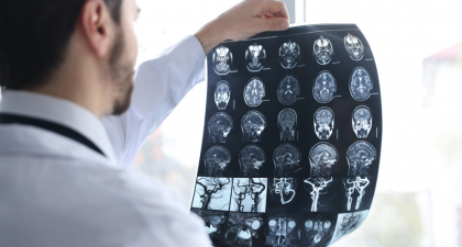 Low birthweight, Stroke risk, Ischemic stroke, Intracerebral hemorrhage, BMI, Early adulthood stroke, Cardiovascular risk, Neurology research, Epidemiology, Preventive medicine, Birth outcomes, Public health, Sweden study, Stroke prevention, Risk factors, gestational age stroke risk, stroke epidemiology, cardiovascular risk factors, neurology research stroke, stroke prevention strategies, population cohort study stroke, adult stroke risk factors, Sweden stroke study