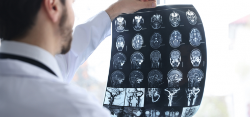 Low birthweight, Stroke risk, Ischemic stroke, Intracerebral hemorrhage, BMI, Early adulthood stroke, Cardiovascular risk, Neurology research, Epidemiology, Preventive medicine, Birth outcomes, Public health, Sweden study, Stroke prevention, Risk factors, gestational age stroke risk, stroke epidemiology, cardiovascular risk factors, neurology research stroke, stroke prevention strategies, population cohort study stroke, adult stroke risk factors, Sweden stroke study