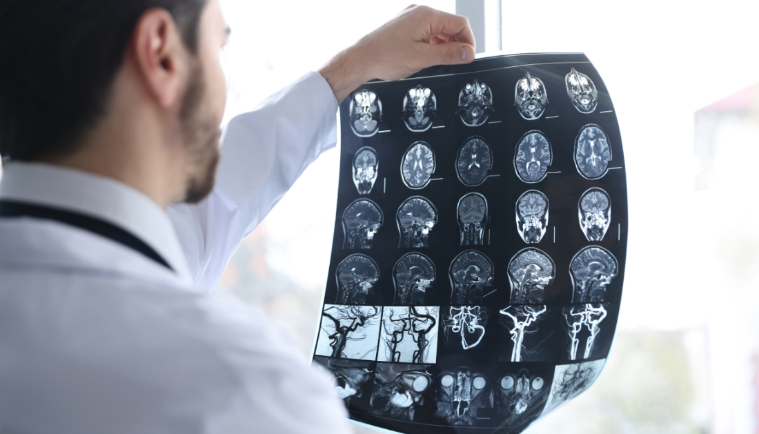 Low birthweight, Stroke risk, Ischemic stroke, Intracerebral hemorrhage, BMI, Early adulthood stroke, Cardiovascular risk, Neurology research, Epidemiology, Preventive medicine, Birth outcomes, Public health, Sweden study, Stroke prevention, Risk factors, gestational age stroke risk, stroke epidemiology, cardiovascular risk factors, neurology research stroke, stroke prevention strategies, population cohort study stroke, adult stroke risk factors, Sweden stroke study