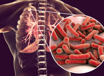 TB vaccines, tuberculosis prevention, VPM1002, Immuvac, extrapulmonary TB, pulmonary TB, latent TB infection, BCG vaccine, TB clinical trial, infectious diseases, global health, vaccine safety, pediatric TB, TB research India, immunization strategies, TB protection, pulmonary tuberculosis, latent TB infection, BCG vaccine limitations, TB prevention strategies, infectious disease research, pediatric TB protection, vaccine safety TB, TB clinical trial India, global TB burden, TB immunization