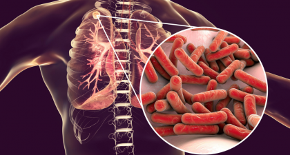 TB vaccines, tuberculosis prevention, VPM1002, Immuvac, extrapulmonary TB, pulmonary TB, latent TB infection, BCG vaccine, TB clinical trial, infectious diseases, global health, vaccine safety, pediatric TB, TB research India, immunization strategies, TB protection, pulmonary tuberculosis, latent TB infection, BCG vaccine limitations, TB prevention strategies, infectious disease research, pediatric TB protection, vaccine safety TB, TB clinical trial India, global TB burden, TB immunization