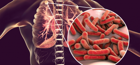 TB vaccines, tuberculosis prevention, VPM1002, Immuvac, extrapulmonary TB, pulmonary TB, latent TB infection, BCG vaccine, TB clinical trial, infectious diseases, global health, vaccine safety, pediatric TB, TB research India, immunization strategies, TB protection, pulmonary tuberculosis, latent TB infection, BCG vaccine limitations, TB prevention strategies, infectious disease research, pediatric TB protection, vaccine safety TB, TB clinical trial India, global TB burden, TB immunization