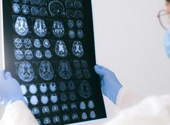 Alzheimer’s Disease, Glucosamine, Dementia, Cognitive Decline, Neurodegenerative Disease, Hyperglycosylation, Brain Health, Neurology Research, Mild Cognitive Impairment, ADRD, Glycan Metabolism, Neuroinflammation, Memory Loss, Nature Metabolism, Alzheimer’s Research, Brain Glycosylation, Neuroinflammation, Memory Deficits, Neurology Research, Alzheimer’s Disease Progression
