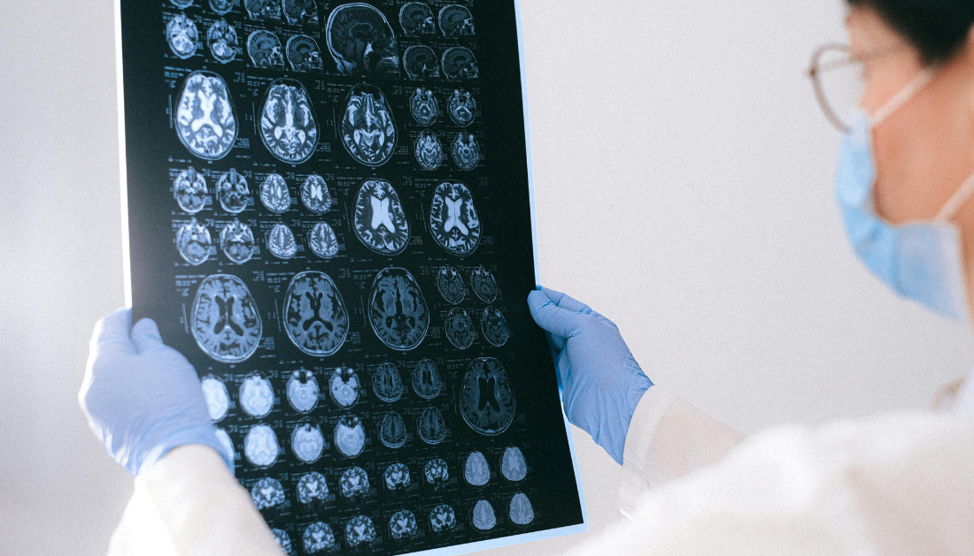 Alzheimer’s Disease, Glucosamine, Dementia, Cognitive Decline, Neurodegenerative Disease, Hyperglycosylation, Brain Health, Neurology Research, Mild Cognitive Impairment, ADRD, Glycan Metabolism, Neuroinflammation, Memory Loss, Nature Metabolism, Alzheimer’s Research, Brain Glycosylation, Neuroinflammation, Memory Deficits, Neurology Research, Alzheimer’s Disease Progression