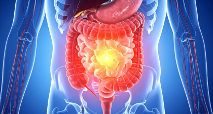 Chronic Xanthan Gum Consumption, Xanthan Gum, Colon Inflammation, Gut Health, Gut Microbiota, Dysbiosis, Intestinal Barrier, Claudin-2, TNF-alpha, IL-1β, PLOS One, Gastroenterology, Food Additives, Dysphagia, Necrotizing Enterocolitis, Intestinal Inflammation, Processed Foods, Nutrition Research, Digestive Health, Preclinical Study, dysbiosis, inflammatory cytokines, IL-1β, TNF-alpha, food additives, necrotizing enterocolitis, gut health, PLOS One study
