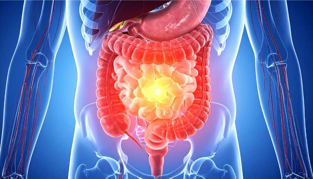 Chronic Xanthan Gum Consumption, Xanthan Gum, Colon Inflammation, Gut Health, Gut Microbiota, Dysbiosis, Intestinal Barrier, Claudin-2, TNF-alpha, IL-1β, PLOS One, Gastroenterology, Food Additives, Dysphagia, Necrotizing Enterocolitis, Intestinal Inflammation, Processed Foods, Nutrition Research, Digestive Health, Preclinical Study, dysbiosis, inflammatory cytokines, IL-1β, TNF-alpha, food additives, necrotizing enterocolitis, gut health, PLOS One study