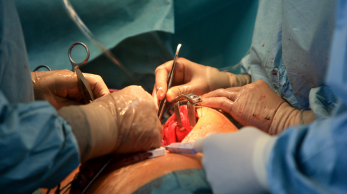 Intravenous Iron, Heart Surgery, Cardiac Surgery, Preoperative Anemia, Red Blood Cell Transfusion, Blood Management, Patient Blood Management, Perioperative Care, Hemoglobin, Cardiology, Cardiothoracic Surgery, Hematology, Anesthesiology, Surgical Recovery, Clinical Trial, Perioperative Anemia, Hemoglobin Optimization, Elective Cardiac Surgery, Cardiothoracic Surgery, Perioperative Care, Clinical Trial