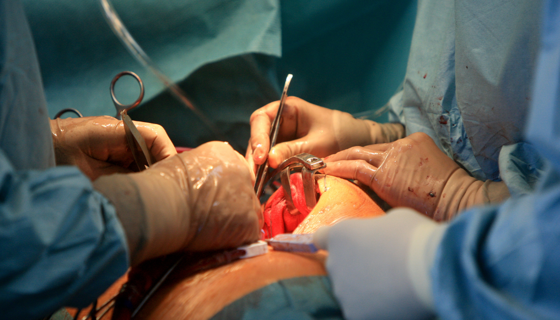 Intravenous Iron, Heart Surgery, Cardiac Surgery, Preoperative Anemia, Red Blood Cell Transfusion, Blood Management, Patient Blood Management, Perioperative Care, Hemoglobin, Cardiology, Cardiothoracic Surgery, Hematology, Anesthesiology, Surgical Recovery, Clinical Trial, Perioperative Anemia, Hemoglobin Optimization, Elective Cardiac Surgery, Cardiothoracic Surgery, Perioperative Care, Clinical Trial
