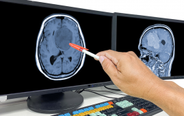 Glioblastoma, Laser Treatment, Laser Interstitial Thermal Therapy, LITT, Brain Tumors, Brain Cancer, Neuro-Oncology, Neurosurgery, Brain Metastases, Cancer Treatment, Minimally Invasive Surgery, Tumor Ablation, Oncology, Neurological Surgery, Cancer Research, glioblastoma surgery, minimally invasive brain surgery, brain metastases treatment, tumor ablation, neuro-oncology, neurosurgery, recurrent glioblastoma, MRI-guided laser therapy