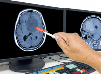 Glioblastoma, Laser Treatment, Laser Interstitial Thermal Therapy, LITT, Brain Tumors, Brain Cancer, Neuro-Oncology, Neurosurgery, Brain Metastases, Cancer Treatment, Minimally Invasive Surgery, Tumor Ablation, Oncology, Neurological Surgery, Cancer Research, glioblastoma surgery, minimally invasive brain surgery, brain metastases treatment, tumor ablation, neuro-oncology, neurosurgery, recurrent glioblastoma, MRI-guided laser therapy