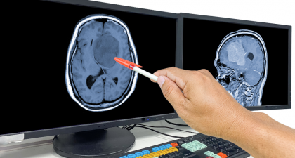 Glioblastoma, Laser Treatment, Laser Interstitial Thermal Therapy, LITT, Brain Tumors, Brain Cancer, Neuro-Oncology, Neurosurgery, Brain Metastases, Cancer Treatment, Minimally Invasive Surgery, Tumor Ablation, Oncology, Neurological Surgery, Cancer Research, glioblastoma surgery, minimally invasive brain surgery, brain metastases treatment, tumor ablation, neuro-oncology, neurosurgery, recurrent glioblastoma, MRI-guided laser therapy