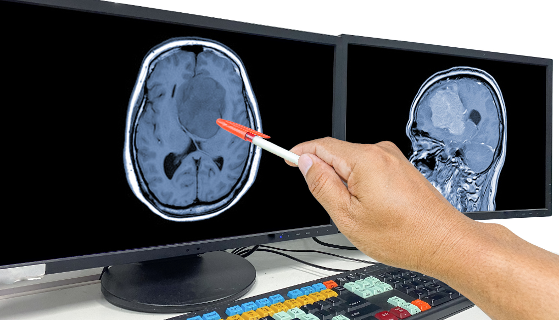 Glioblastoma, Laser Treatment, Laser Interstitial Thermal Therapy, LITT, Brain Tumors, Brain Cancer, Neuro-Oncology, Neurosurgery, Brain Metastases, Cancer Treatment, Minimally Invasive Surgery, Tumor Ablation, Oncology, Neurological Surgery, Cancer Research, glioblastoma surgery, minimally invasive brain surgery, brain metastases treatment, tumor ablation, neuro-oncology, neurosurgery, recurrent glioblastoma, MRI-guided laser therapy