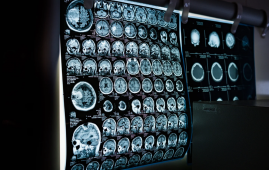 Brain Development, Copy Number Variants, Neuronal Development, Genomic Integrity, Synaptic Pruning, Neurodevelopmental Disorders, Autism Research, Neuroscience, Neurology, Neuronal Cell Death, Harvard Medical School, Boston Children's Hospital, Nature Study, Epilepsy Research, Alzheimer's Disease, neuron elimination, synaptic connections, neuronal cell death, prenatal brain development, genetic abnormalities in neurons, neuroscience research, Alzheimer's disease research