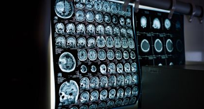 Brain Development, Copy Number Variants, Neuronal Development, Genomic Integrity, Synaptic Pruning, Neurodevelopmental Disorders, Autism Research, Neuroscience, Neurology, Neuronal Cell Death, Harvard Medical School, Boston Children's Hospital, Nature Study, Epilepsy Research, Alzheimer's Disease, neuron elimination, synaptic connections, neuronal cell death, prenatal brain development, genetic abnormalities in neurons, neuroscience research, Alzheimer's disease research
