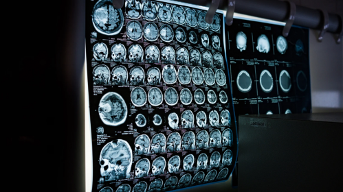 Brain Development, Copy Number Variants, Neuronal Development, Genomic Integrity, Synaptic Pruning, Neurodevelopmental Disorders, Autism Research, Neuroscience, Neurology, Neuronal Cell Death, Harvard Medical School, Boston Children's Hospital, Nature Study, Epilepsy Research, Alzheimer's Disease, neuron elimination, synaptic connections, neuronal cell death, prenatal brain development, genetic abnormalities in neurons, neuroscience research, Alzheimer's disease research