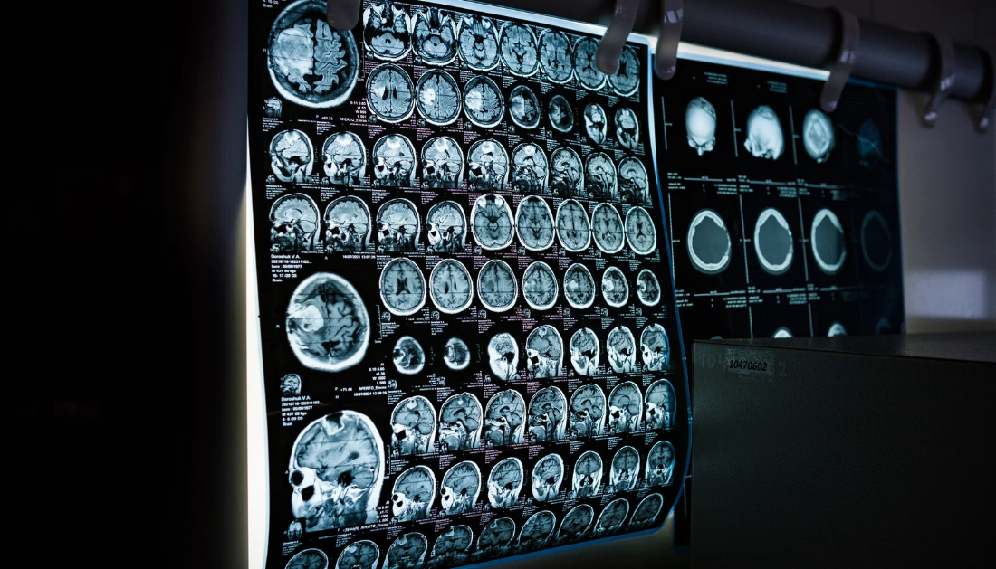 Brain Development, Copy Number Variants, Neuronal Development, Genomic Integrity, Synaptic Pruning, Neurodevelopmental Disorders, Autism Research, Neuroscience, Neurology, Neuronal Cell Death, Harvard Medical School, Boston Children's Hospital, Nature Study, Epilepsy Research, Alzheimer's Disease, neuron elimination, synaptic connections, neuronal cell death, prenatal brain development, genetic abnormalities in neurons, neuroscience research, Alzheimer's disease research