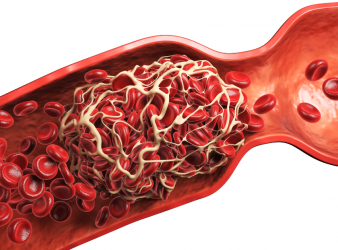 Coffee Consumption, coffee consumption and recurrent VTE, recurrent venous thromboembolism, coffee and blood clots, recurrent VTE risk, coffee consumption and VTE, venous thromboembolism recurrence, blood clot recurrence, deep vein thrombosis (DVT), pulmonary embolism (PE), provoked VTE, unprovoked VTE, VTE risk factors, anticoagulation therapy, thrombosis research, recurrent blood clots