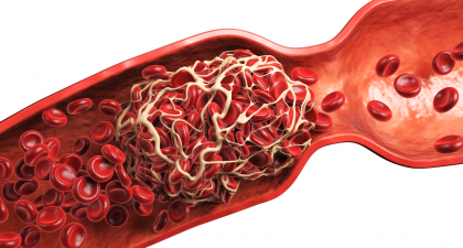 Coffee Consumption, coffee consumption and recurrent VTE, recurrent venous thromboembolism, coffee and blood clots, recurrent VTE risk, coffee consumption and VTE, venous thromboembolism recurrence, blood clot recurrence, deep vein thrombosis (DVT), pulmonary embolism (PE), provoked VTE, unprovoked VTE, VTE risk factors, anticoagulation therapy, thrombosis research, recurrent blood clots