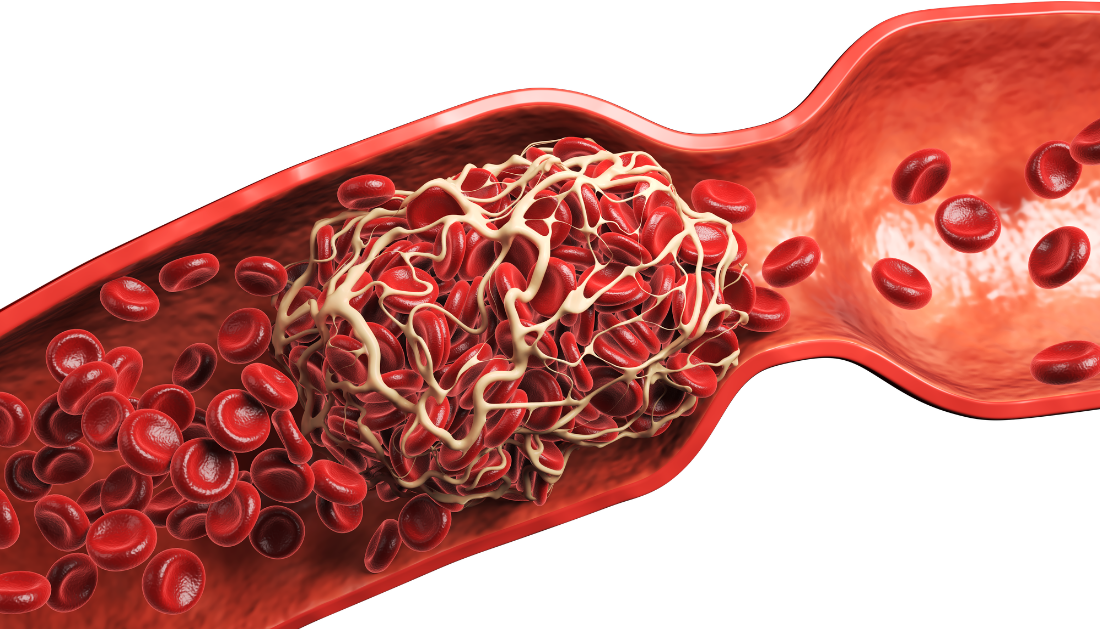 Coffee Consumption, coffee consumption and recurrent VTE, recurrent venous thromboembolism, coffee and blood clots, recurrent VTE risk, coffee consumption and VTE, venous thromboembolism recurrence, blood clot recurrence, deep vein thrombosis (DVT), pulmonary embolism (PE), provoked VTE, unprovoked VTE, VTE risk factors, anticoagulation therapy, thrombosis research, recurrent blood clots